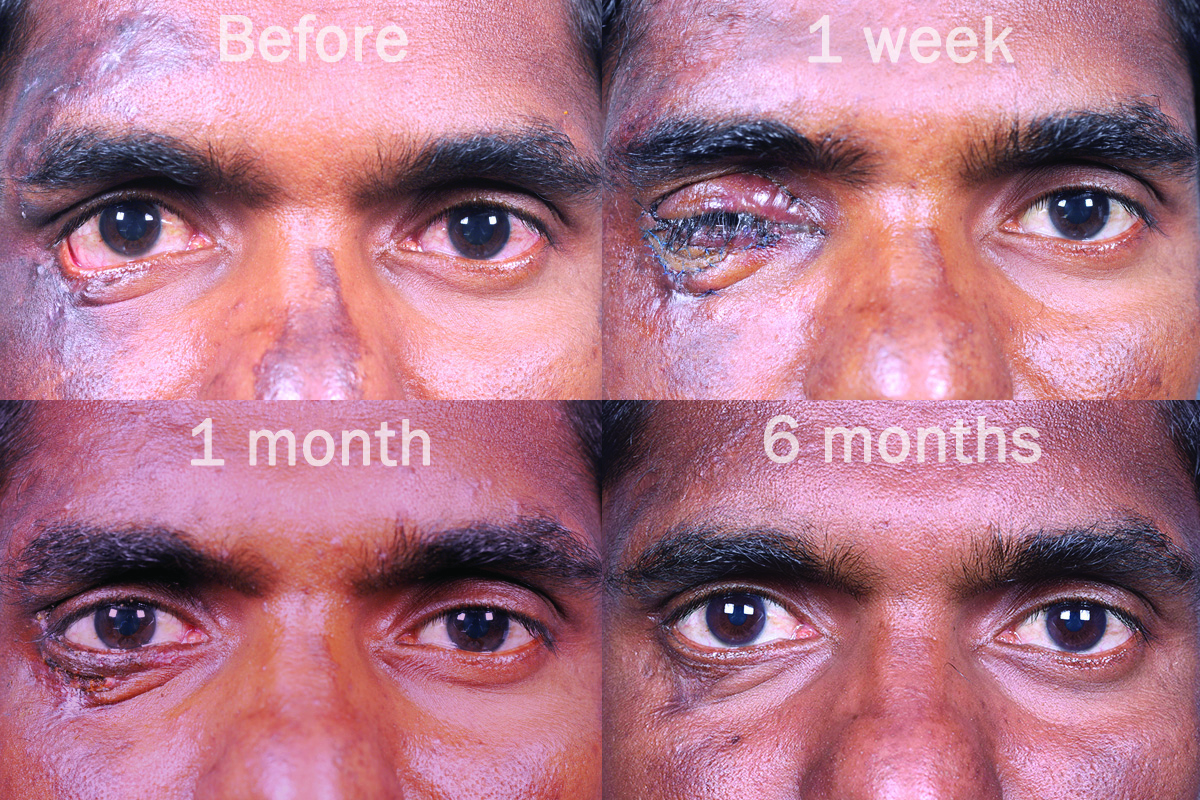 Entropion, Ectropion and Lid abnormalities